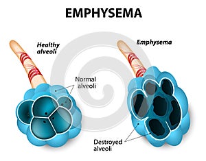 Emphysema