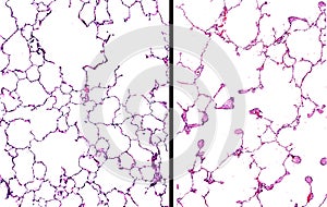 Emphysema in the lungs