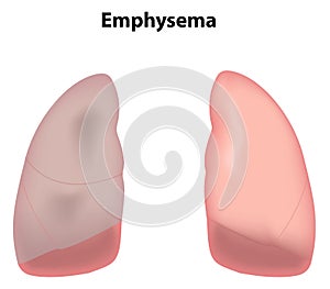 Emphysema of the Lungs