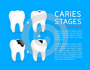 Tooth on different stages of dental caries development.