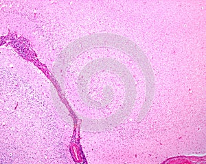 Encephalitis by Haemophilus influenzae