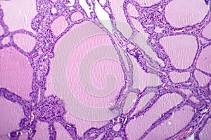 Endemic goiter, light micrograph