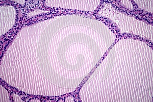 Endemic goiter, light micrograph