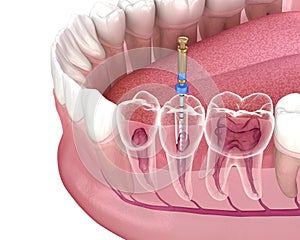 Endodontic root canal treatment process. Medically accurate tooth 3D illustration