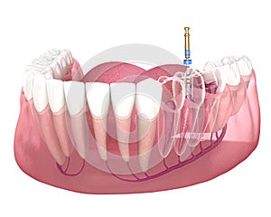 Endodontic root canal treatment process. Medically accurate tooth 3D illustration