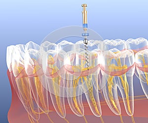 Endodontic root canal treatment process. Medically accurate tooth 3D illustration