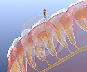 Endodontic root canal treatment process. Medically accurate tooth 3D illustration