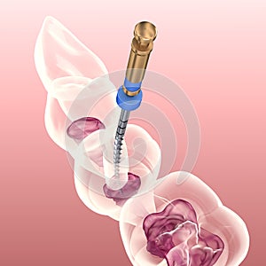 Endodontic root canal treatment process. Medically accurate tooth 3D illustration