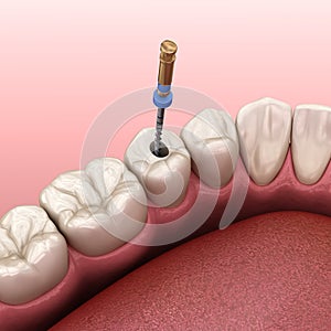 Endodontic root canal treatment process. Medically accurate tooth 3D illustration