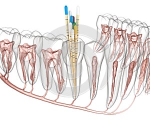 Endodontic root canal treatment process. Medically accurate tooth 3D illustration