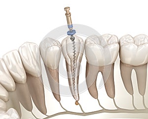 Endodontic root canal treatment process. Medically accurate tooth 3D illustration