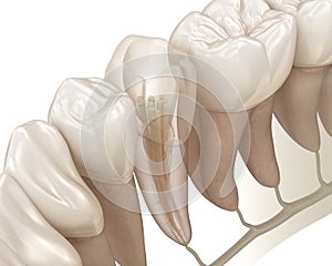 Endodontic root canal treatment process. Medically accurate tooth 3D illustration