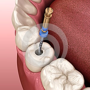 Endodontic root canal treatment process. Medically accurate tooth illustration photo