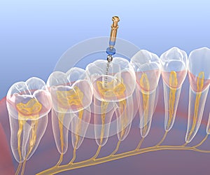 Endodontic root canal treatment process. Medically accurate tooth 3D illustration photo