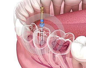 Endodontic root canal treatment process. Medically accurate tooth 3D illustration photo