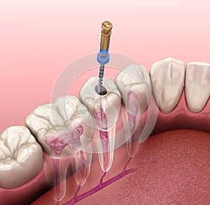 Endodontic root canal treatment process. Medically accurate tooth illustration