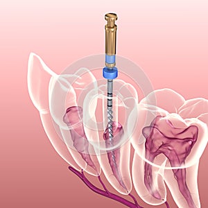 Endodontic root canal treatment process. Medically accurate tooth illustration