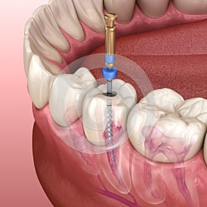 Endodontic root canal treatment process. Medically accurate tooth illustration