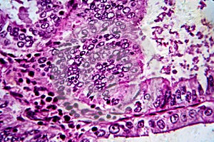 Endometrial adenocarcinoma, light micrograph photo