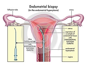 Endometrial biopsy diagram