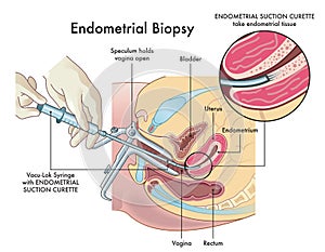 Endometrial biopsy procedure