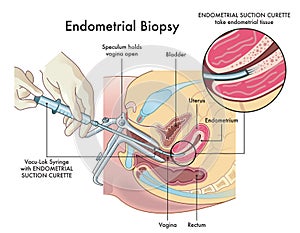Endometrial biopsy procedure photo