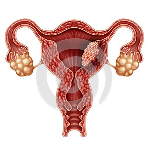 Endometrial Cancer photo