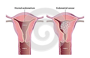 Endometrial cancer medical illustration