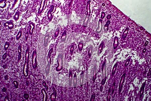 Endometrial hyperplasia, light micrograph photo