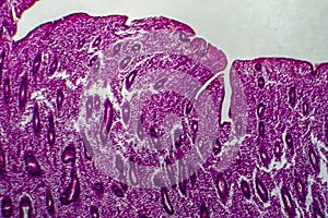 Endometrial hyperplasia, light micrograph photo