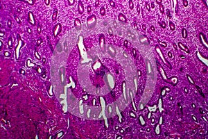 Endometrial hyperplasia, light micrograph