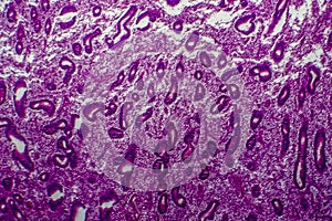 Endometrial hyperplasia, light micrograph