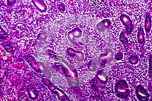 Endometrial hyperplasia, light micrograph