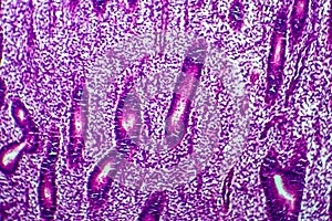 Endometrial hyperplasia, light micrograph