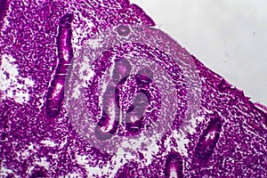Endometrial hyperplasia, light micrograph