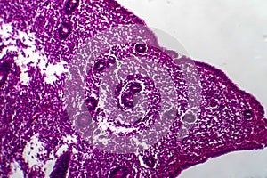 Endometrial hyperplasia, light micrograph