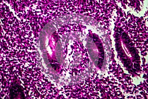 Endometrial hyperplasia, light micrograph