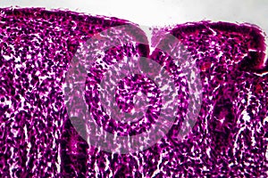 Endometrial hyperplasia, light micrograph