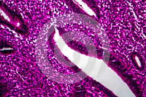 Endometrial hyperplasia, light micrograph