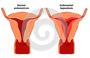 Endometrial hyperplasia