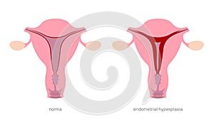 Endometrial hyperplasia in uterus medical illustration. Precancerous condition of female endometrium.