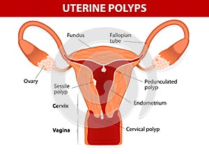 Endometrial polyp or uterine polyp photo