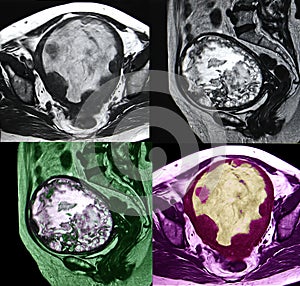 Endometrial tumor, MRI
