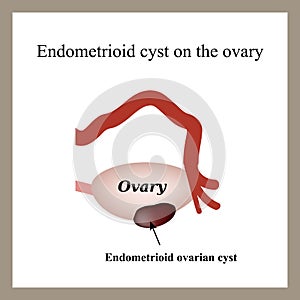 Endometrioid cyst on the ovary. Endometriosis. Ovary.