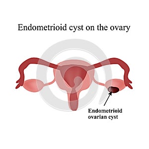 Endometrioid cyst on the ovary. Endometriosis. Ovary. Infographics. Vector illustration on isolated background