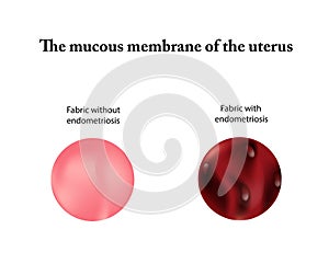 Endometriosis. Adenomyosis. The endometrium. Vector illustration on isolated background photo