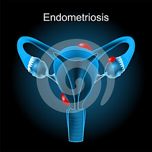 Endometriosis. Cross section of a human uterus