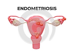 Endometriosis is a disease characterized by the presence of endometrium outside the uterine cavity and in other organs