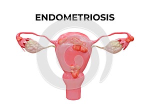 Endometriosis is a disease characterized by the presence of endometrium outside the uterine cavity and in other organs photo