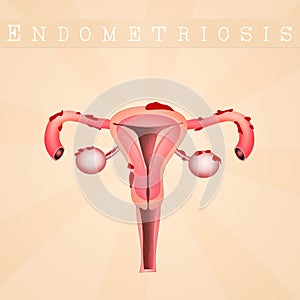 Endometriosis disease photo